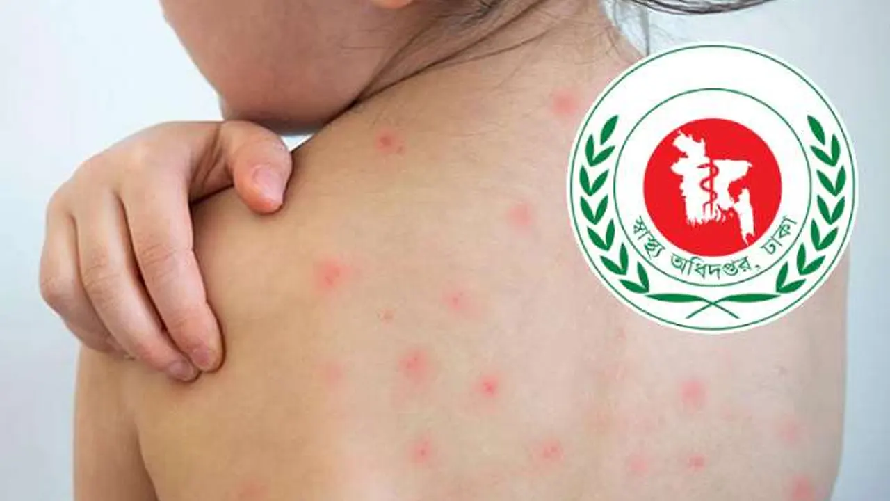 ৮৯ দিনে হাম ও উপসর্গে ৬৪৩ জনের মৃত্যু